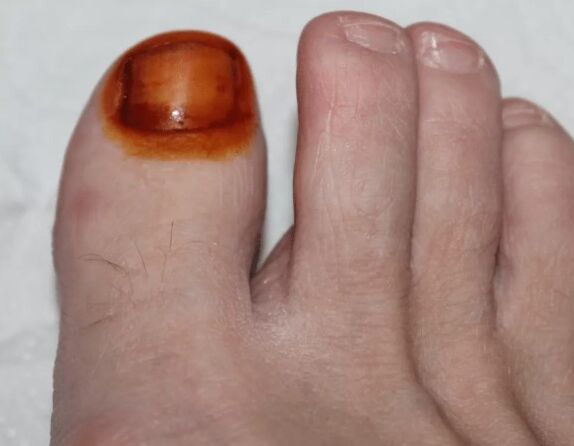 Treatment of fungal iodine