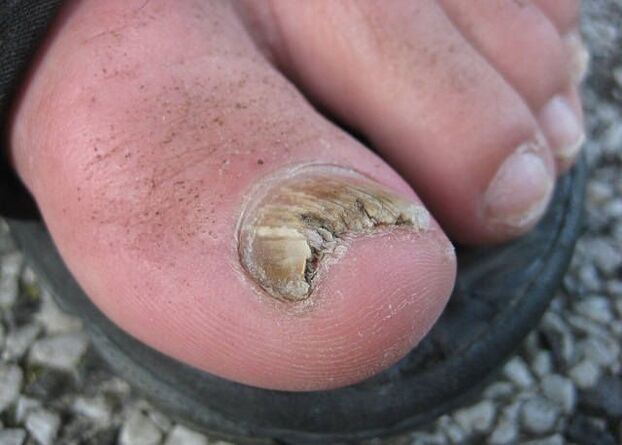 The result of neglect