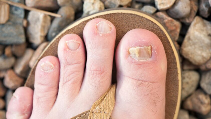 Nail fungus