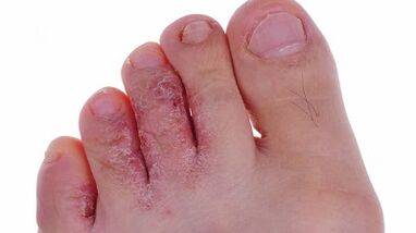 Types and stages of development of fungi in the legs