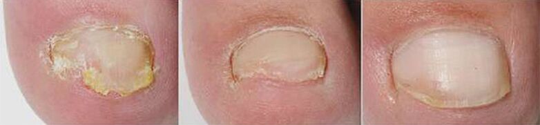 The results of therapy