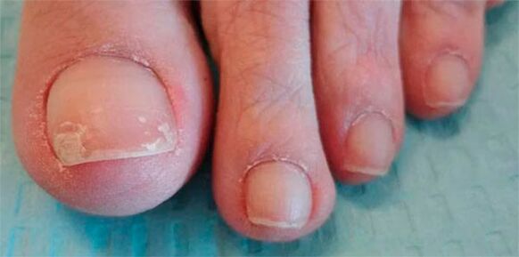 the stages of fungal legs