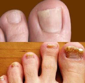 initial and advanced stages of athlete's foot