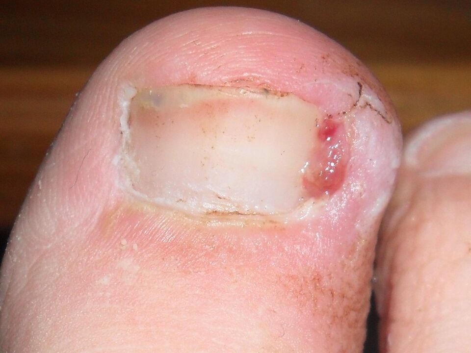 ingrown toenails as a symptom of a fungal infection