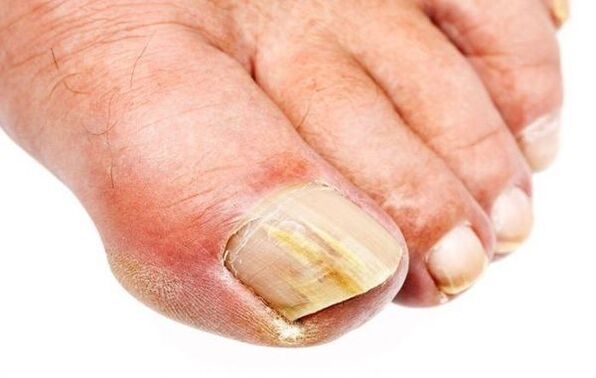 Onychomycosis - toenail fungus