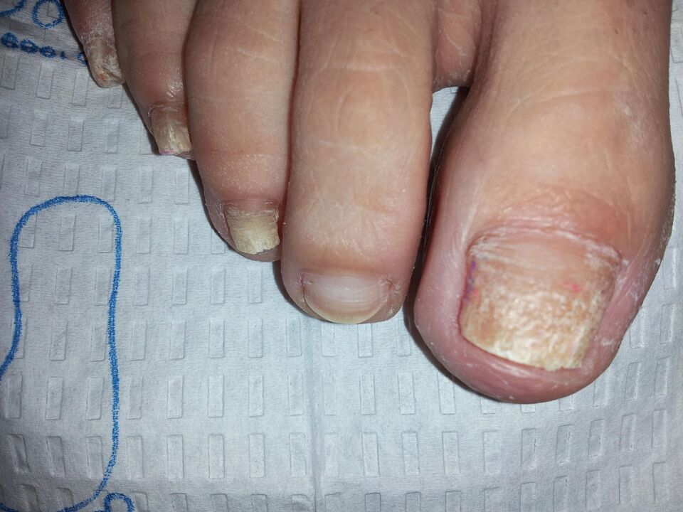 How to treat toenail fungus with celandine