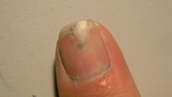 Symptoms of nail fungus