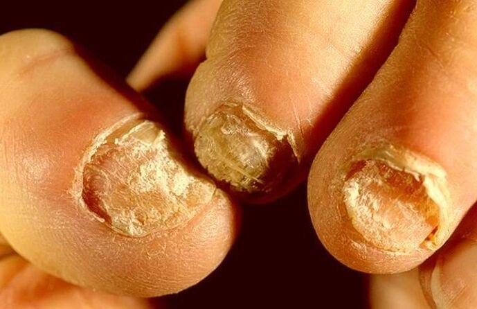 how to treat nail fungus